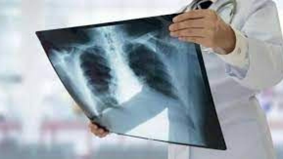 altText(Más de 1,6 millones de personas murieron por tuberculosis en 2021)}